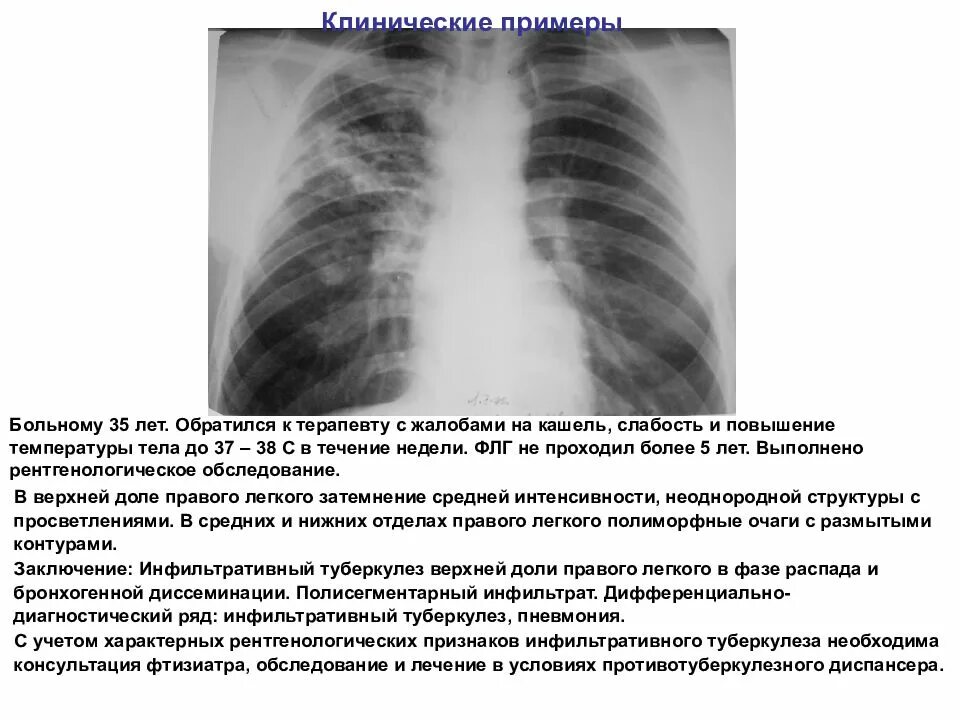 Диссеминированный туберкулез фаза инфильтрации. Инфильтративный туберкулез в фазе инфильтрации. Инфильтративный туберкулез верхней доли рентген. Инфильтративный туберкулез Лобит рентген. Инфильтративный туберкулез нижней доли правого легкого.