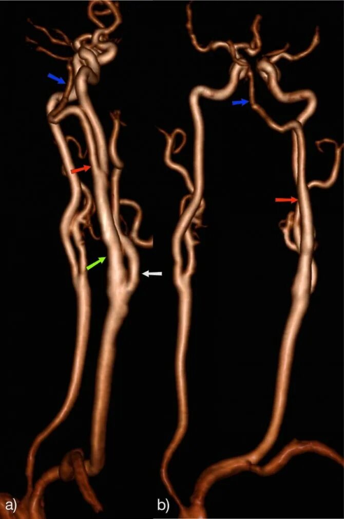 Гипоплазия позвоночной артерии мрт. Гипоплазия v4 позвоночной артерии. Гипоплазия позвоночной артерии кт. Аномалии отхождения позвоночной артерии. Гипоплазия правой артерии мозга