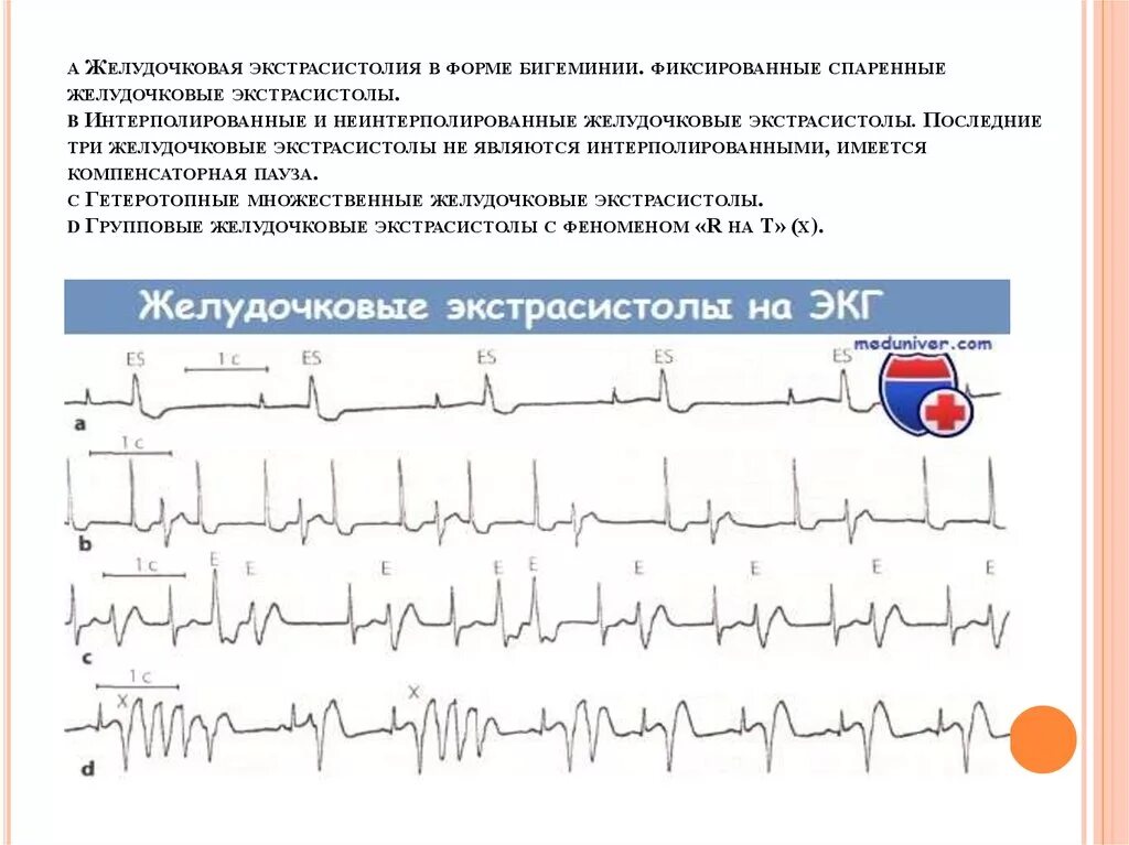 Экстрасистолы на ЭКГ бигеминия. Желудочковая экстрасистолия квадригеминия на ЭКГ. Наджелудочковая экстрасистолия бигеминия ЭКГ. Предсердная бигеминия на ЭКГ. Типы желудочковых экстрасистол