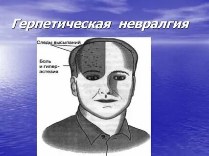 Герпетическая невралгия