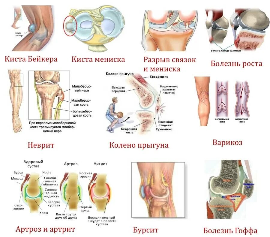 Болит внутри колена под чашечкой. Колющая боль в коленном суставе. Очень сильно болит колено что делать