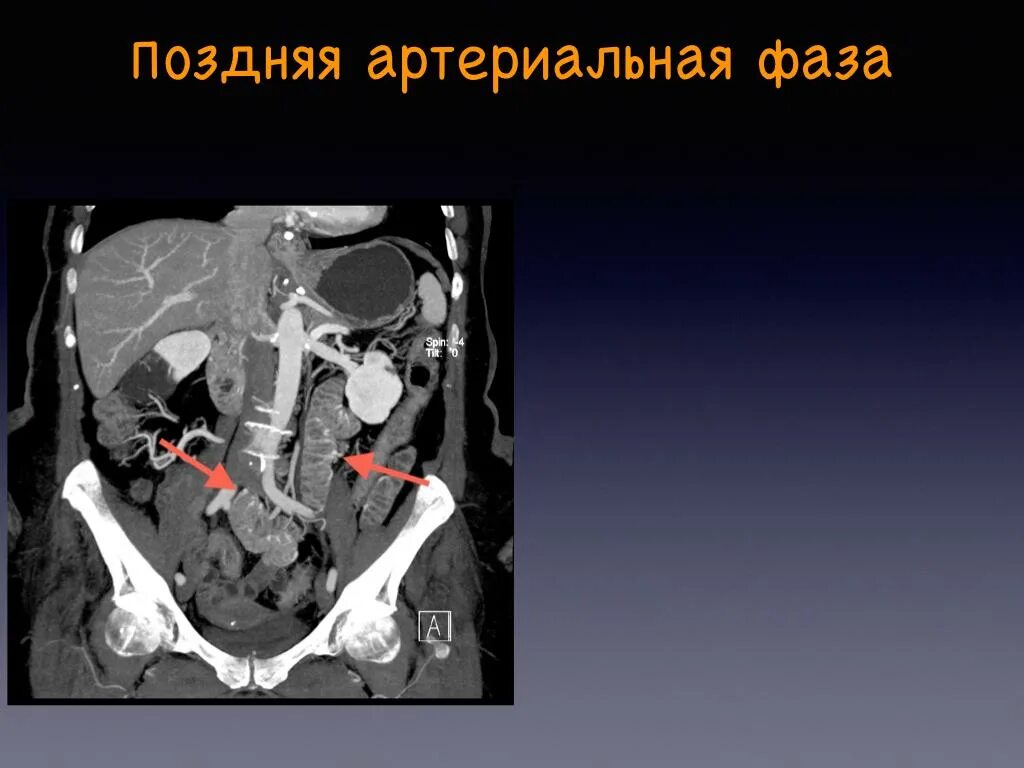 Компьютерная томография с контрастированием брюшной полости. Кт артериальная фаза контрастирования. поздняя артериальная фаза контрастирования на кт. кт брюшной полости аксиальный срез. кт органов брюшной полости с контрастированием.