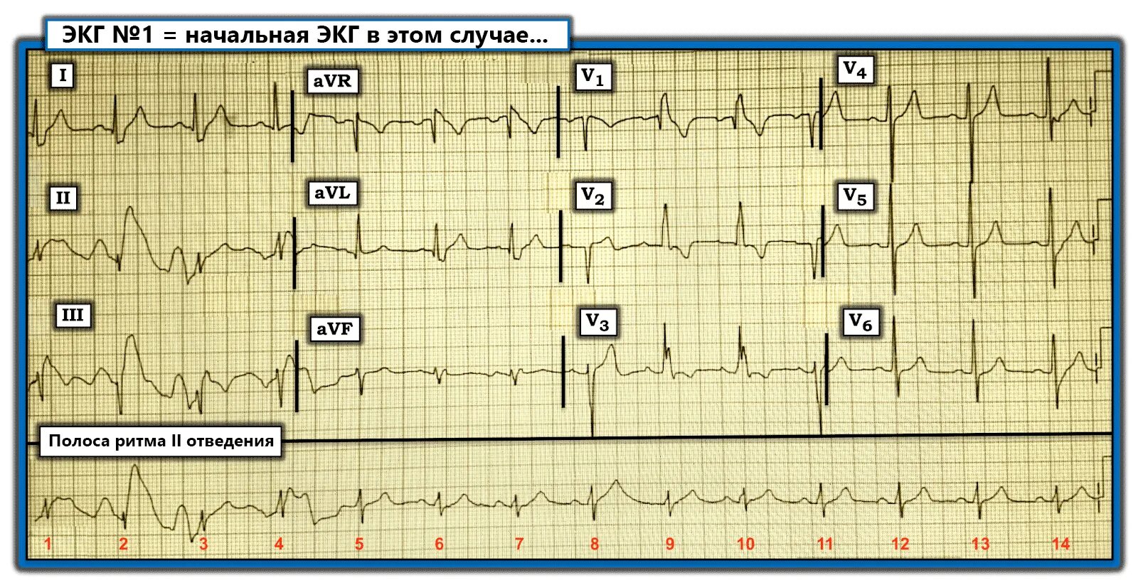 3 Стандартное отведение ЭКГ. Отведение v1 на ЭКГ. ЭКГ 2 отведение норма. 1 Стандартное отведение ЭКГ. Тяжелое экг