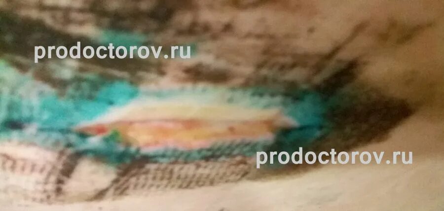 Как убрать швы после операции. Подкожный шов после операции. разошелся шов после операции. воспалилась нитка в шве после операции. желтая жидкость из шва после операции.