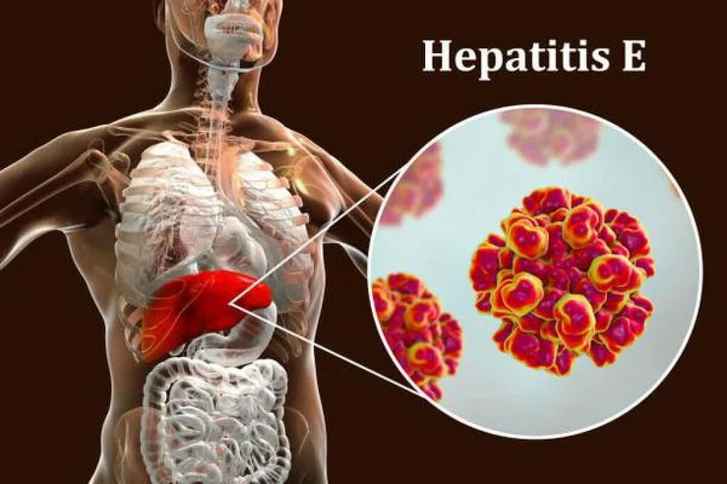 Гепатит е. Вирус гепатита e. Гепатит е эпидемиология. Гепатит е структура. Кишечный гепатит