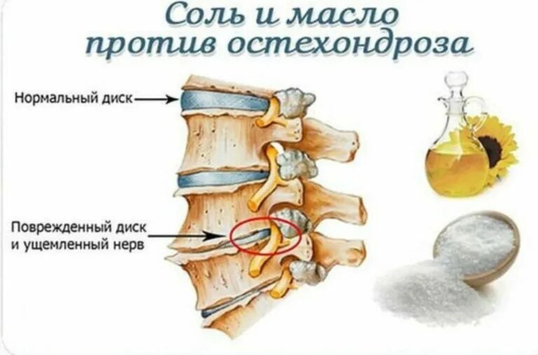 Защемление нерва в спине поясница. Защемление нерва при остеохондрозе. Защемление поясничного нерва. Защемление поясничного отдела позвоночника.