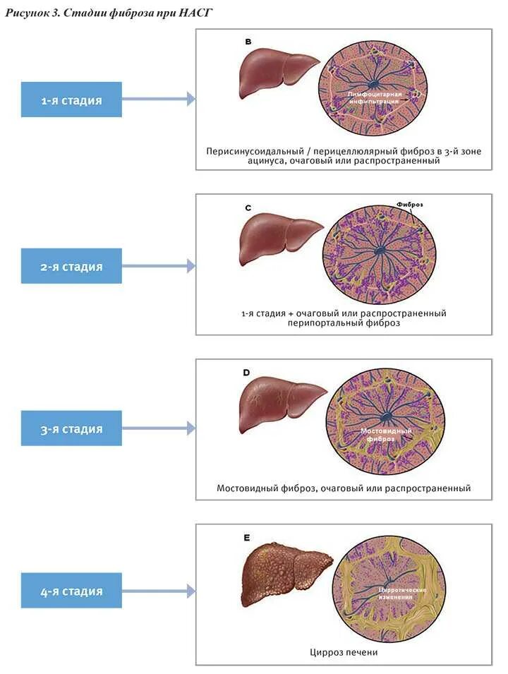Фиброз metavir. Перицеллюлярный фиброз. Стадии фиброз печени f2. Симптомы стадий фиброза печени.