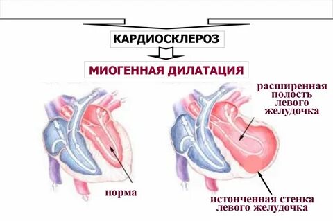 Дилатация левого желудочка и правого желудочка