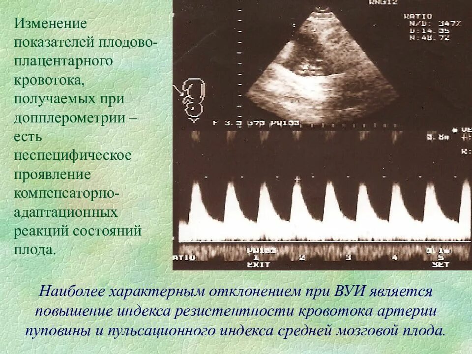 Повышен маточный кровоток. Допплер маточно плацентарного кровотока норма. индекс резистентности в средней мозговой артерии плода. допплерометрия пупочной артерии. допплерография маточных артерий норма.