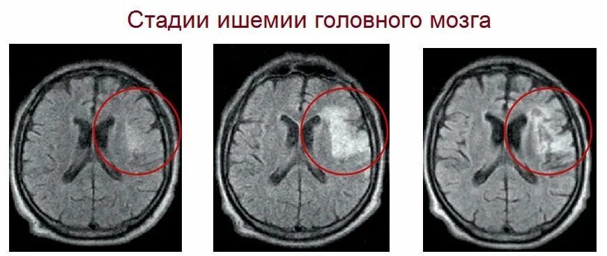 Ишемия головы