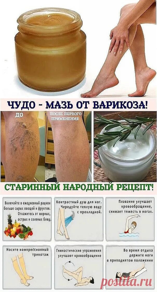 Варикозное расширение вен нижних конечностей уксус. Народные средства от варикоза. Народные средства от варикоза вен. Народные средства от варикоза вен. Народные средства для вен на ногах.