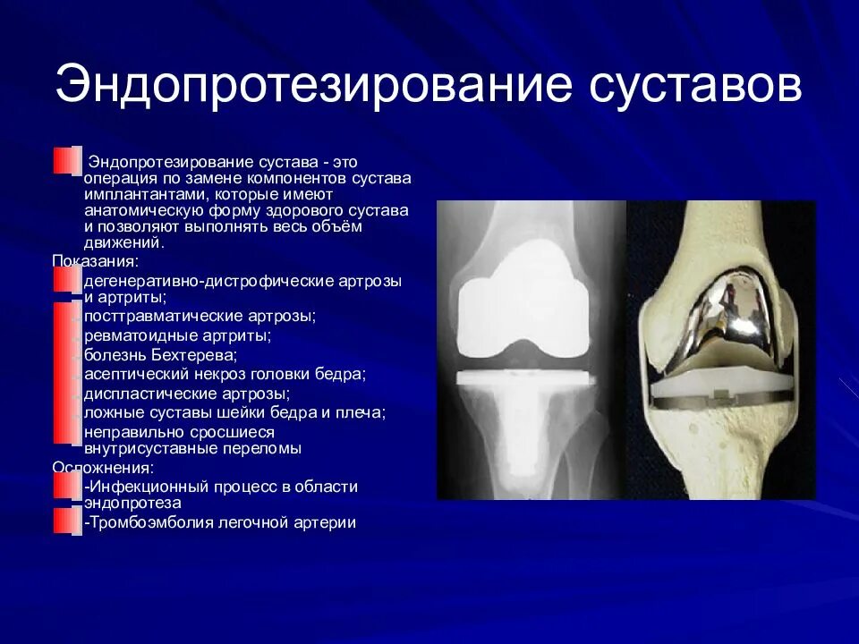 Суть операции эндопротезирования. Эндопротезирование суставов презентация. Показания для эндопротезирования суставов. Показания для эндопротезироания коленного устава. Эндопротезирование сустава хирург.