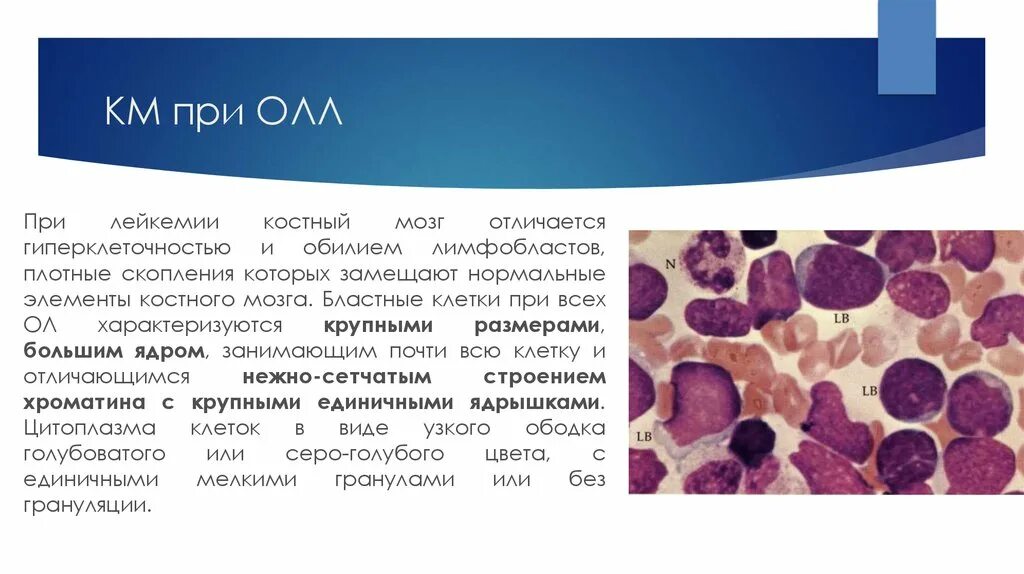 Бластные клетки в костном мозге. Острый лимфобластный лейкоз костный мозг. Острый лимфобластный лейкоз исследования костного мозга. Миелоидный лейкоз костного мозга.