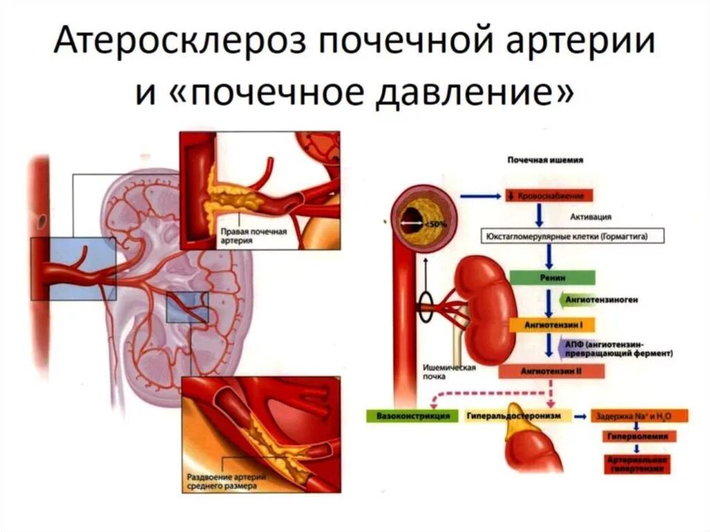 Атеросклероз артерий почек почечная форма. Осложнения атеросклероза артерий почек. Атеросклероз почечных сосудов характеризуется:. Гипертоническая болезнь сосуды почек. Тромбоз почечных вен