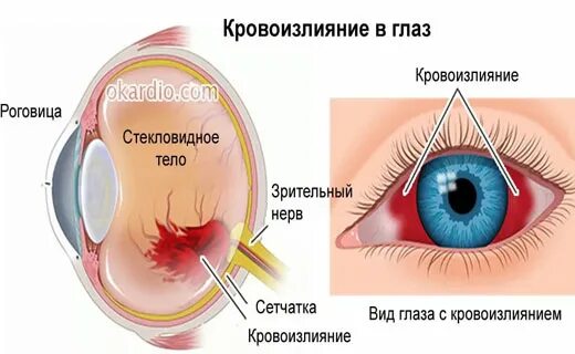 Субконъюнктивальное кровоизлияние. Пли для глаз кровоизлияние в глаз. Капли для глаз от кровоизлияния в глазу.