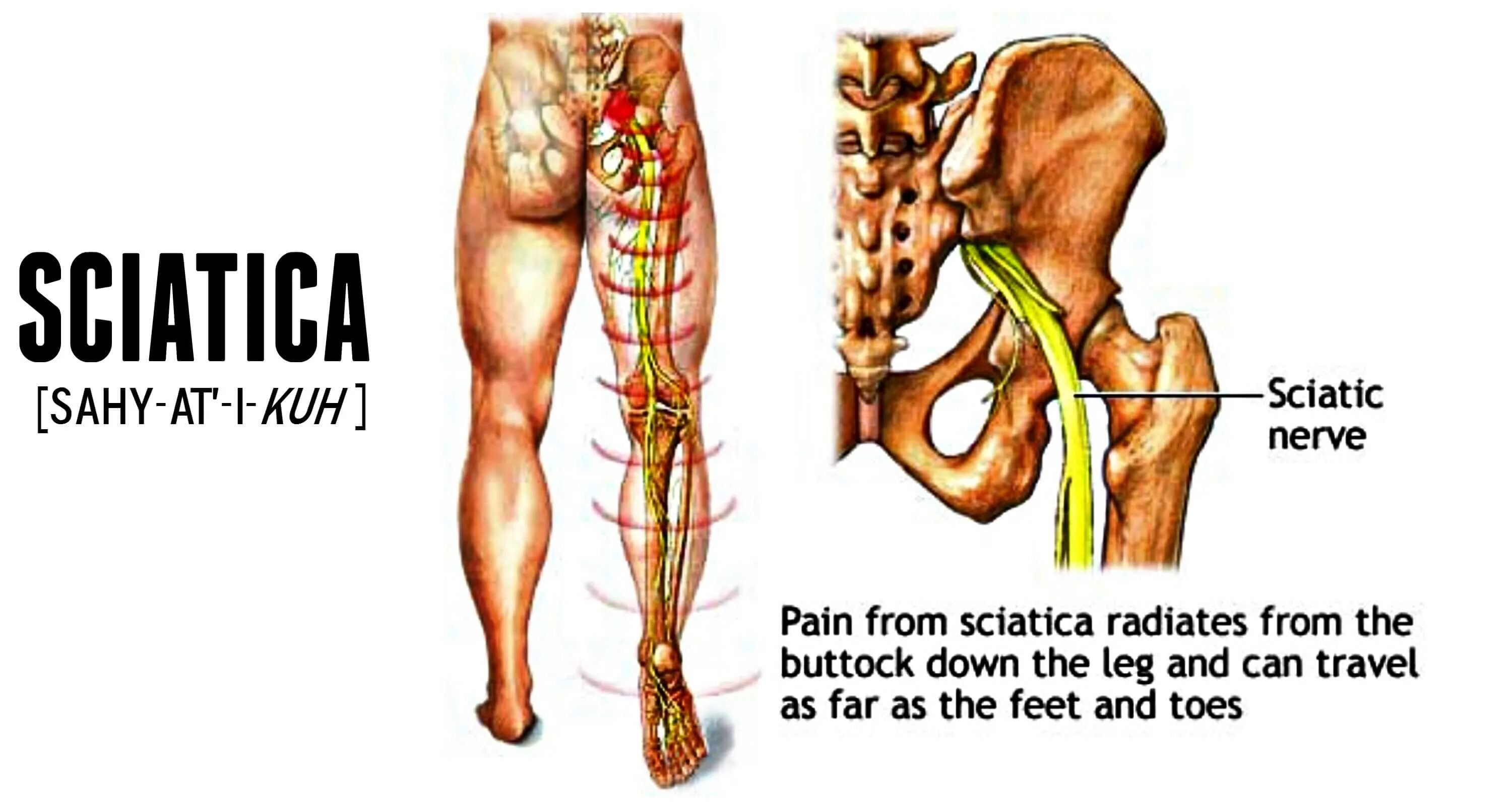 седалищный нерв анатомия. седалищный нерв схема расположения. седалищный нерв анатомия схема. синдром поражения седалищного нерва. седалищный нерв на картинке сзади.