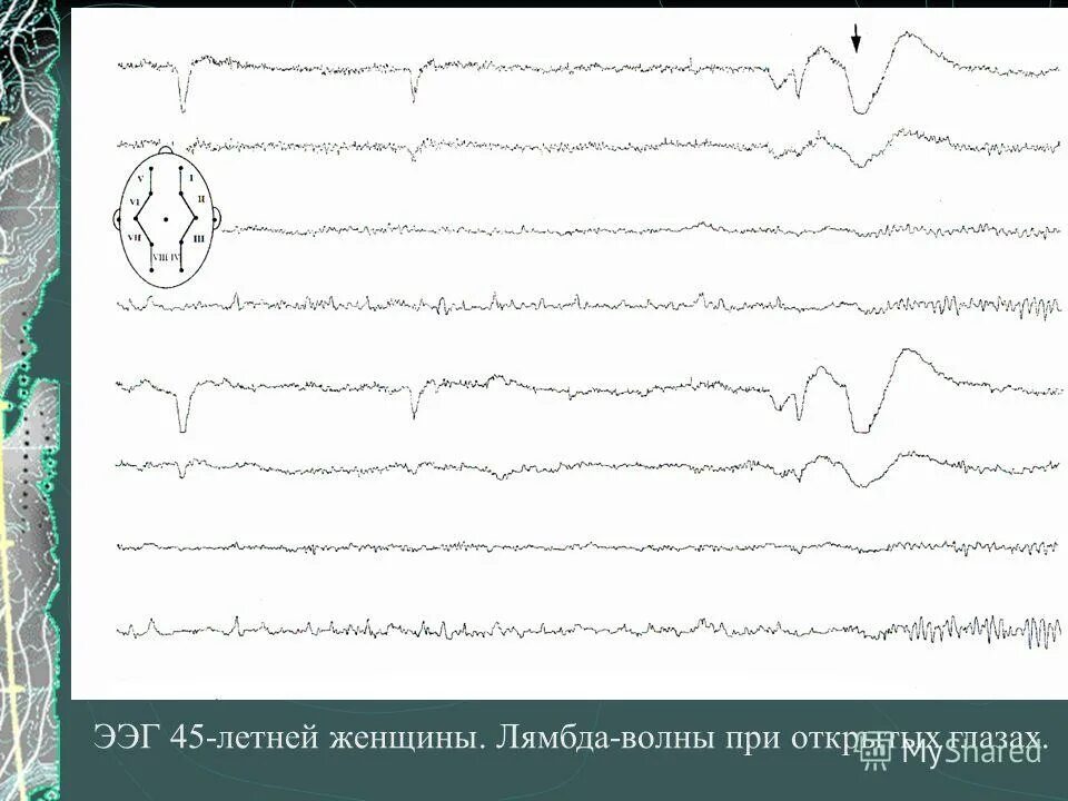 Записаться на ээг. ЭЭГ волны. Лямбда волны на ЭЭГ. Электроэнцефалография волны. ЭЭГ при коме.