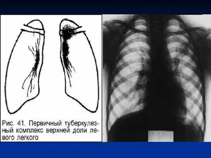 Диагностика туберкулеза рентген