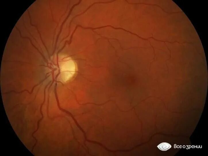 Болезнь глазного дна. Гипертоническая ретинопатия глазное дно. Гипертензивная ангиопатия сетчатки. Гипертензионная ангиопатия сетчатки что это. Почечная ретинопатия глазное дно.