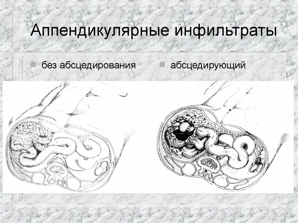 Абсцесс аппендицита осложнения