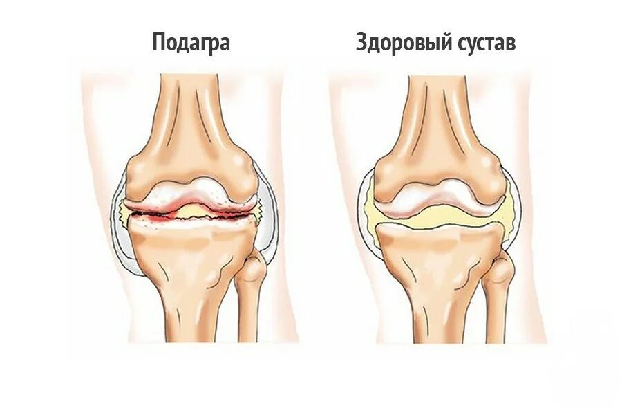 Изменения в коленных суставах. Деформирующий остеоартроз. Первичный деформирующий остеоартроз. Подагрический артрит коленного сустава. Деформирующий артроз (остеоартроз).