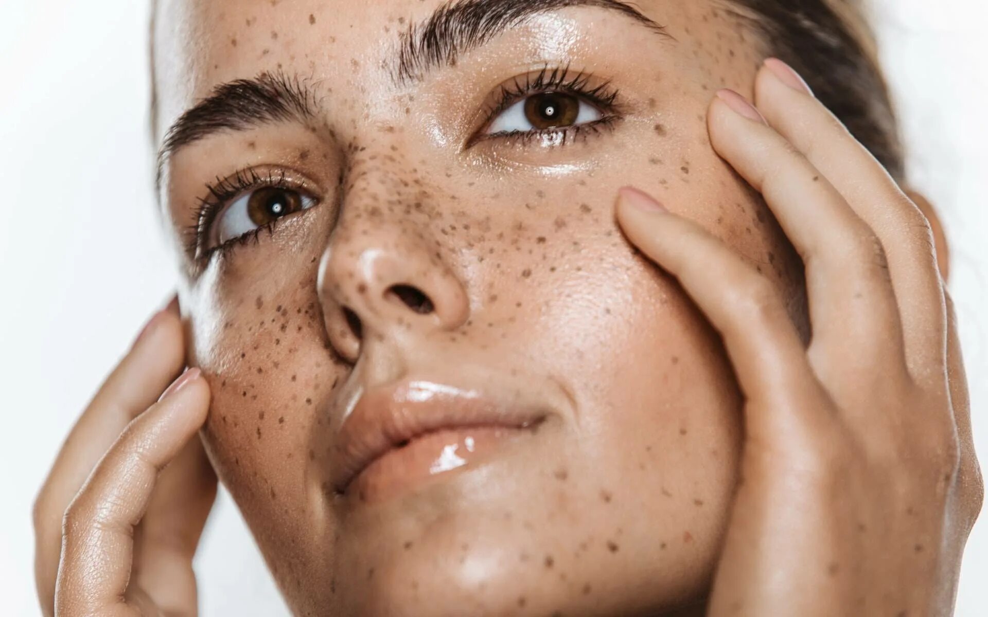 Меланина лицо. Гиперпигментация кожи лица. Гиперпигментация хлоазма. Веснушки, лентиго, мелазма. Гиперпигментация кожи лица.