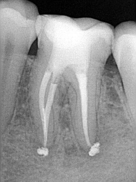 Травматический пульпит. Травматический периодонтит. Пломбирование зуба после лечения каналов