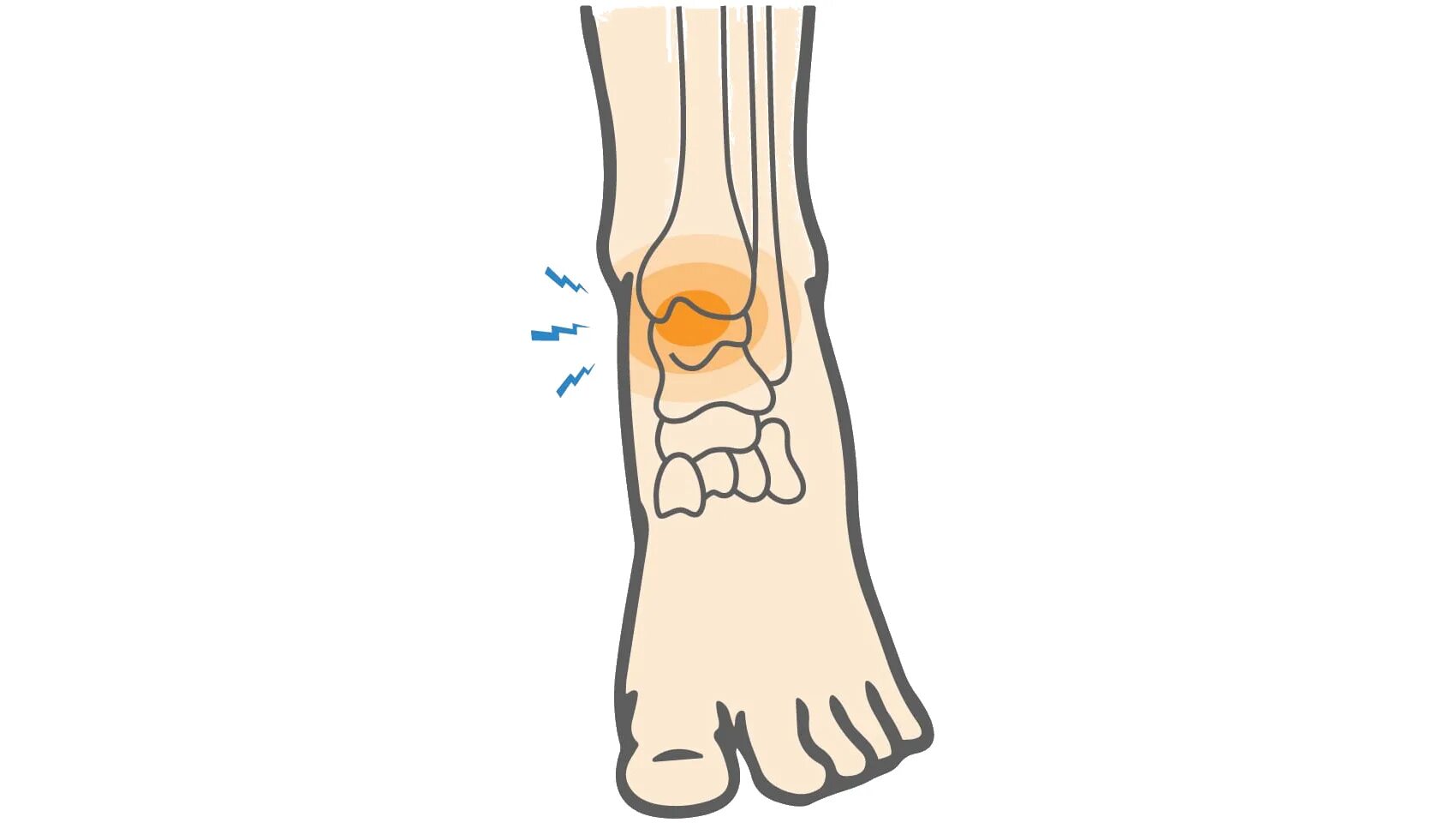 травма голеностопного сустава. медиальный лодыжка перелом кости. перелом голеностопного сустава боли. перелом голеностопного сустава боли. остеоартроз голеностопных.