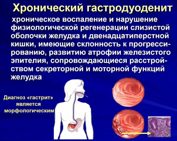 Гастродуоденит болит. Хронический гастрит дуоденит. Клинические проявления гастродуоденита. Симптомы хронического гастродуоденита. Хронический гастродуоденит синдромы.