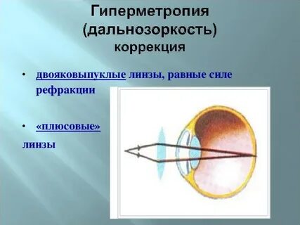 Коррекция дальнозоркости