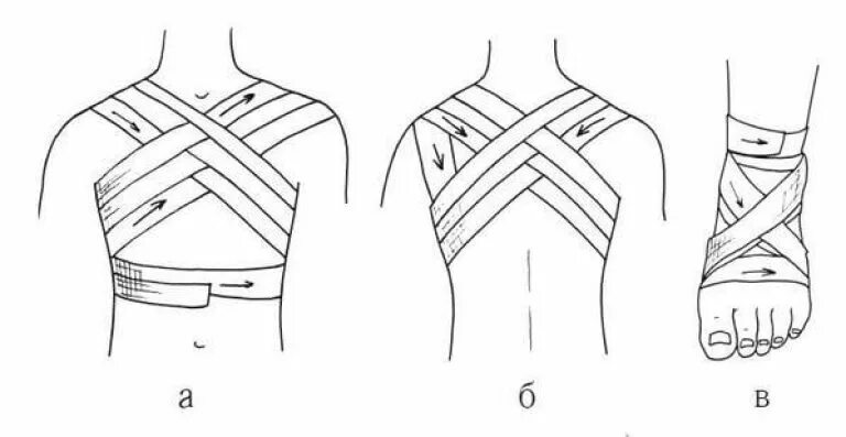 Перевязка шеи. Перелом ключицы восьмиобразная повязка. Крестообразная (восьмиобразная) повязка. Крестообразная повязка техника наложения. Восьмиобразная повязка техника наложения.