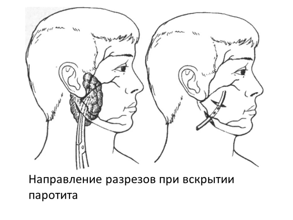 Околоушная железа операция. Доступы для вскрытия Гнойного паротита. Гнойный паротит околоушной слюнной железы. Вскрытие абсцесса околоушной слюнной железы. Направление хирургического разреза при Гнойном паротите.