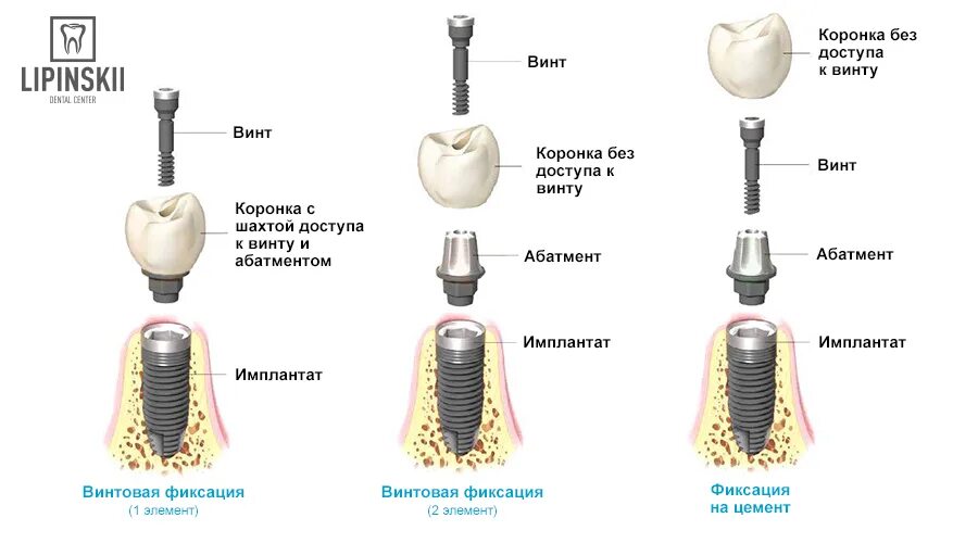 Схема установки зубного имплантата. Сколько занимает установка импланта. Этапы имплантации зуба абатмент. Двухэтапная методика имплантации зубов. Хирургический этап дентальной имплантации.