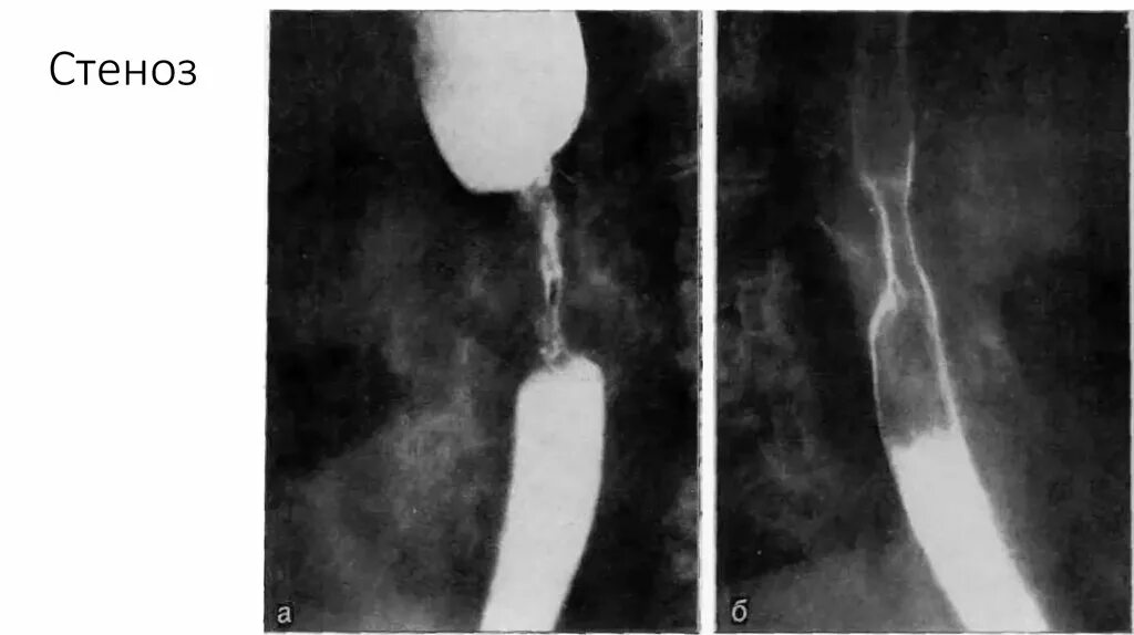 Сужение пищевода симптомы. Рубцовая стриктура пищевода рентген. Рубцовый стеноз пищевода рентген. Стриктура пищевода рентген симптомы. Атрезия пищевода рентген.