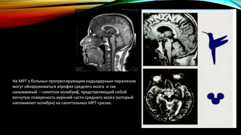 Атрофия головного мозга лечение. Атрофия среднего мозга мрт. Прогрессирующий надъядерный паралич. Прогрессивный надъядерный паралич мрт. Симптом Колибри на мрт.