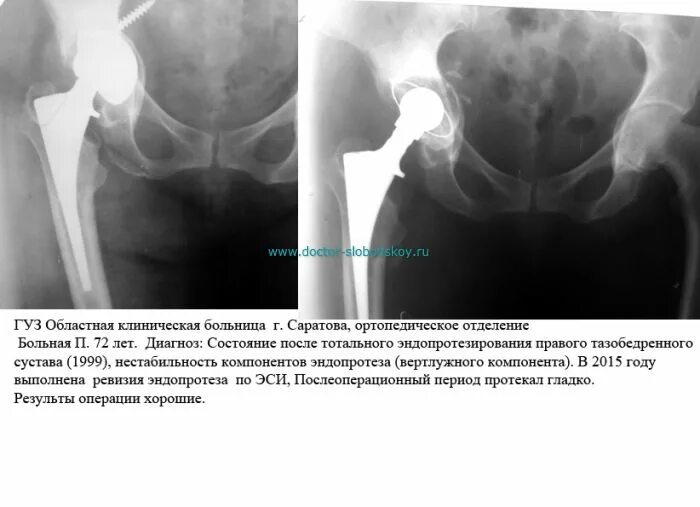 Нестабильность тазобедренного сустава. Нестабильность эндопротеза тазобедренного сустава кт. рентген после эндопротезирования тазобедренного сустава. вертлужного компонента эндопротеза тазобедренного сустава рентген. рентген признаки нестабильности эндопротеза тазобедренного сустава.