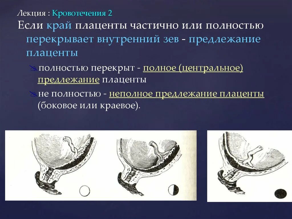 Полное предлежание форум. Предлежание плаценты 2 степени. Предлежание плаценты внутренний зев. Плацента перекрывает внутренний зев. Полное или частичное предлежание плаценты.