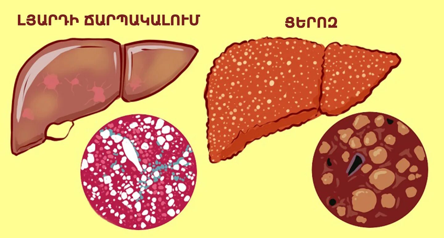 Гепатоз ожирение печени. Печень рисунок. Гепатоз печени диета.