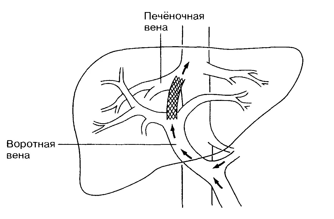 Расширенные вены печени. Схема воротной вены печени. Воротная Вена печени система. Воротная Вена печени схема. Система воротной вены печени схема движения крови.