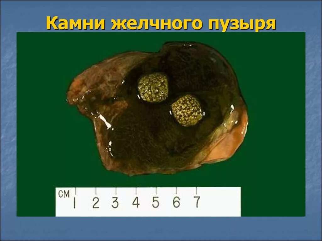 Жкб печени. Камни в жёлчном пузыре пузыре. Камен в желичем пузеие. Камн и в желечном пузыре.