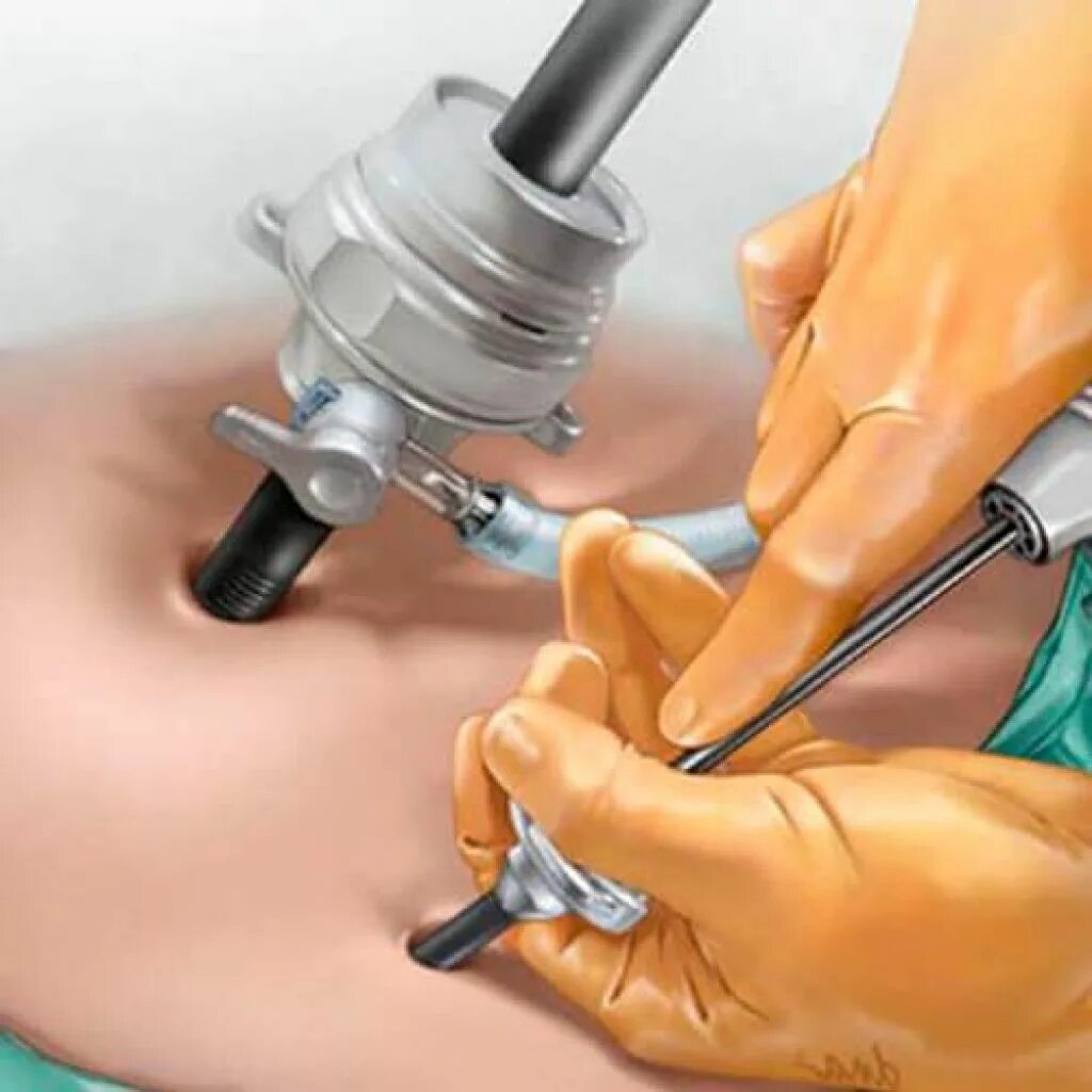 Можно ли после гинекологической операции. Можно ли после гинекологической операции. Виды операций в гинекологии. Можно ли после гинекологической операции. Операционная гистероскопия.