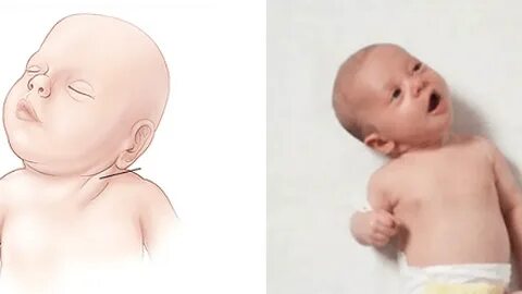 Младенец голова в одну сторону