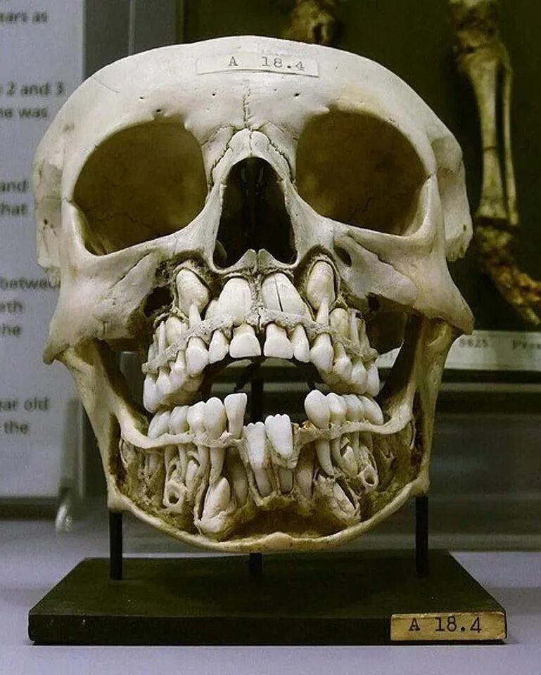 Череп малыша. Рентген черепа ребенка коренные зубы. Рентген черепа с молочными зубами.