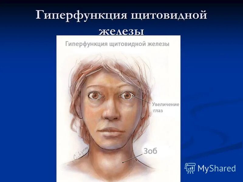 При гиперфункции щитовидной железы возникает. Гиперфункция щитовидной железы, базедова болезнь. Гиперфункция щитовидной железы болезни. Гиперфункция щитовидных желез. Гиперфункция щитовидной железы.