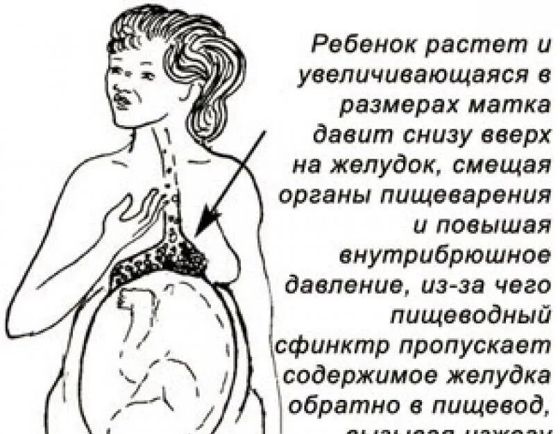 Можно ли внутрь при беременности. Симптомы изжоги при беременности 2 триместр. изжога при беременности 3 триместр. желудок при беременности. изжоге прибеременночти.
