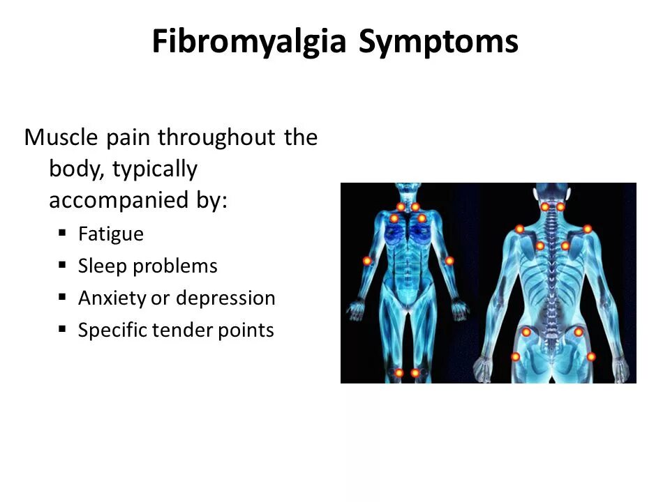 Фибромиалгия у женщин лечение после 50. Фибромиалгия. Точки боли при фибромиалгии. Фибромиалгия патогенез. Фибромиалгия это аутоиммунное заболевание.