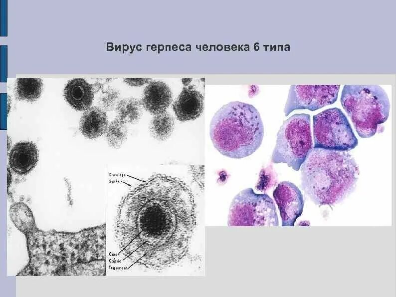 1 2 6 типа вируса. Герпесвирус человека 6 типа. типы вируса герпеса человека.