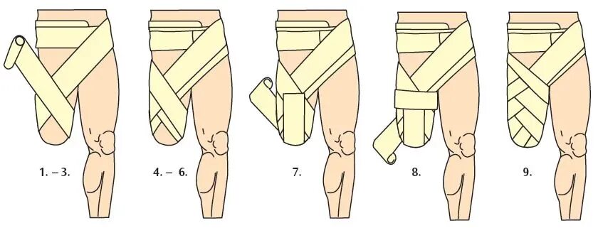 Эластичное бинтование культи бедра. Бинтование культи голени. Бинтование культи эластичным бинтом. Возвращающаяся повязка на культю бедра.
