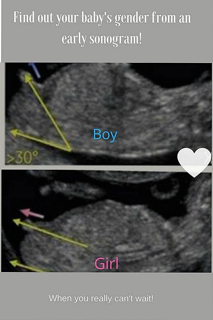Пол ребенка на УЗИ. Пол на УЗИ. УЗИ определение пола. Как по УЗИ определяют пол ребенка. Как отличить на узи