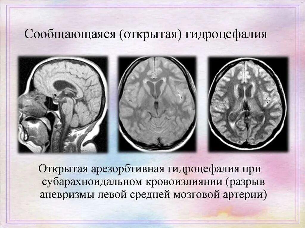 Желудочки головного мозга при гидроцефалии. Наружная водянка. Клинические симптомы гидроцефалии. Гидроцефалия головного. Клинические симптомы гидроцефалии.